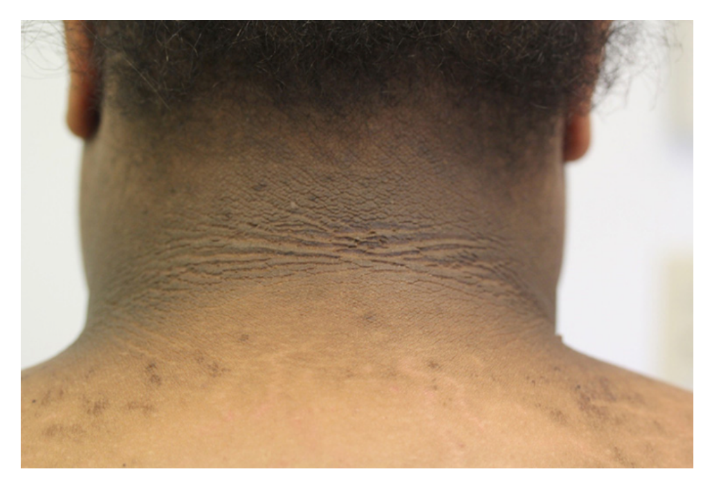 fig-semio-acantose-nigricans