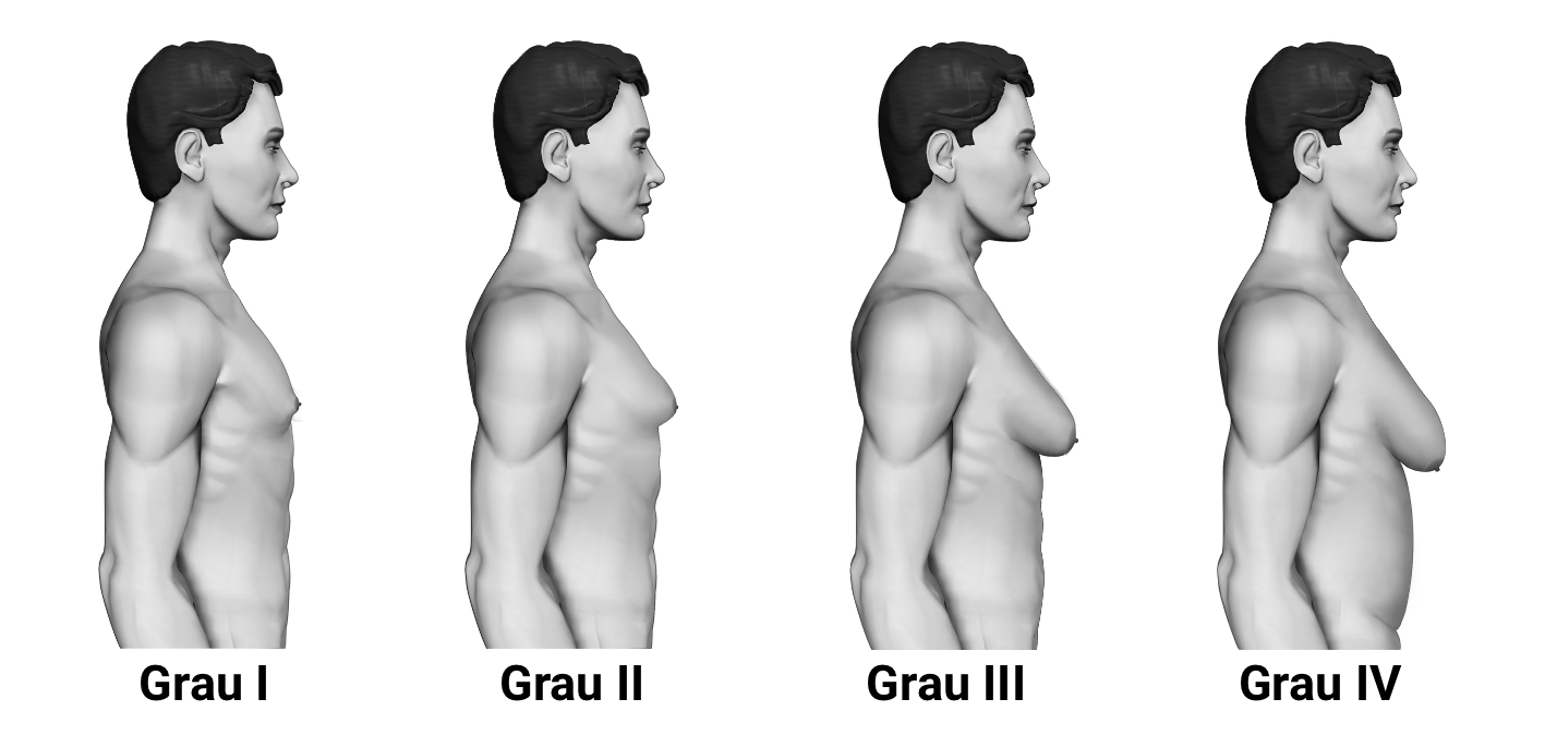 fig-semio-classificacao-ginecomastia