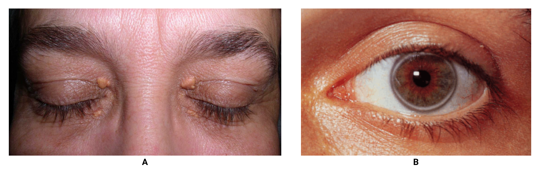 fig-semio-olhos-dislipidemia